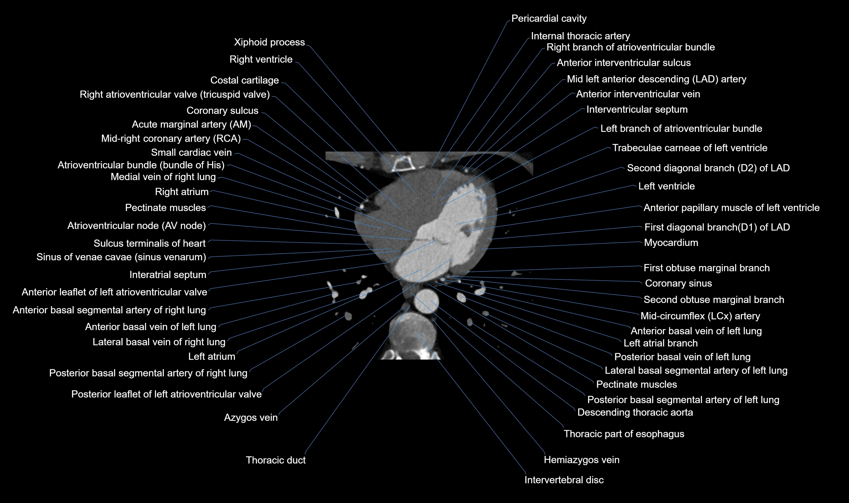 CT heart (coronary angiogram) axial view cross sectional anatomy labelled radiology image-00041.webp